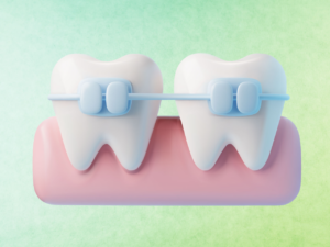 Traditional Metal Braces